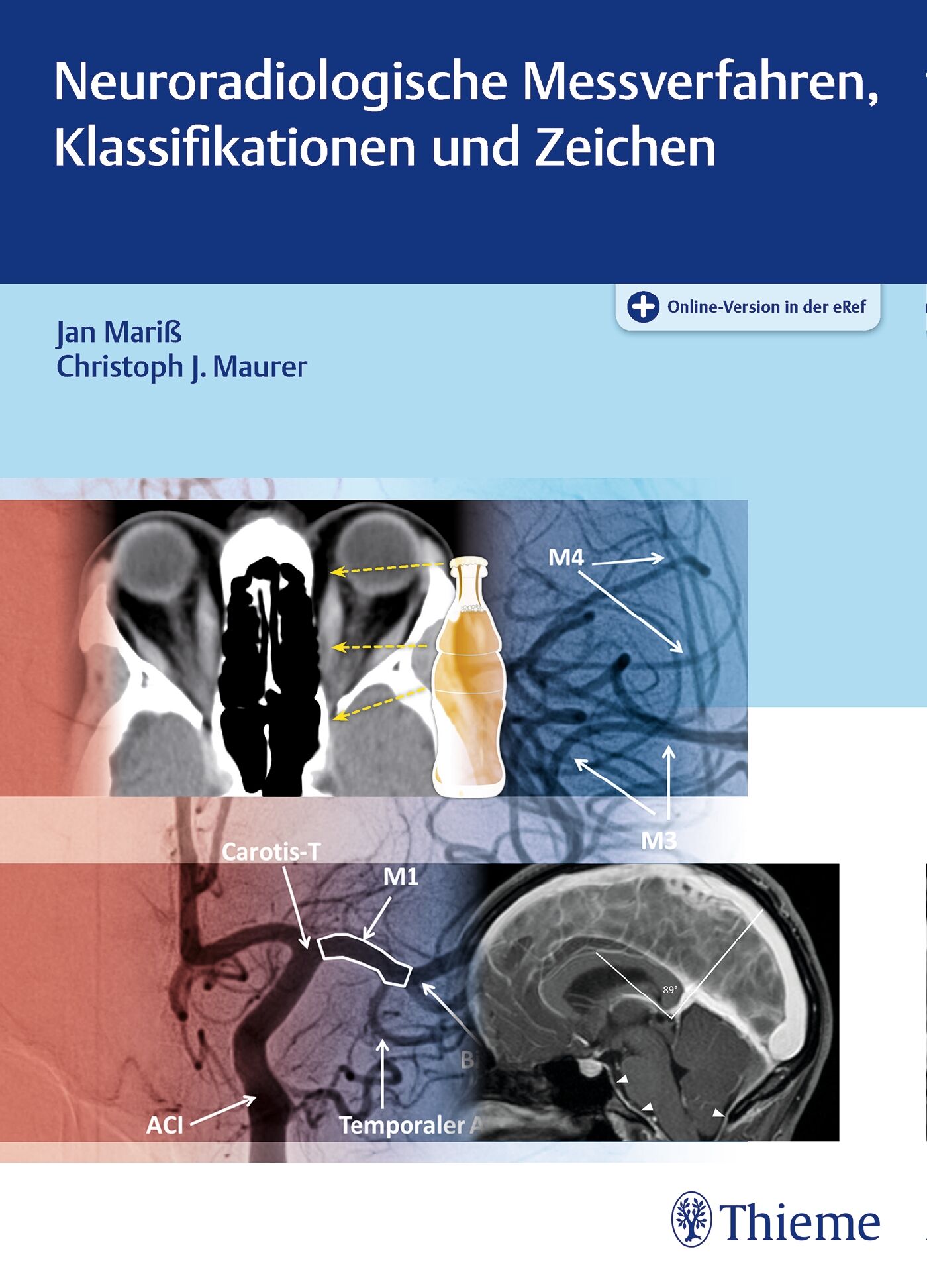Neuroradiologische Messverfahren, Klassifikationen und Zeichen, 9783131754615