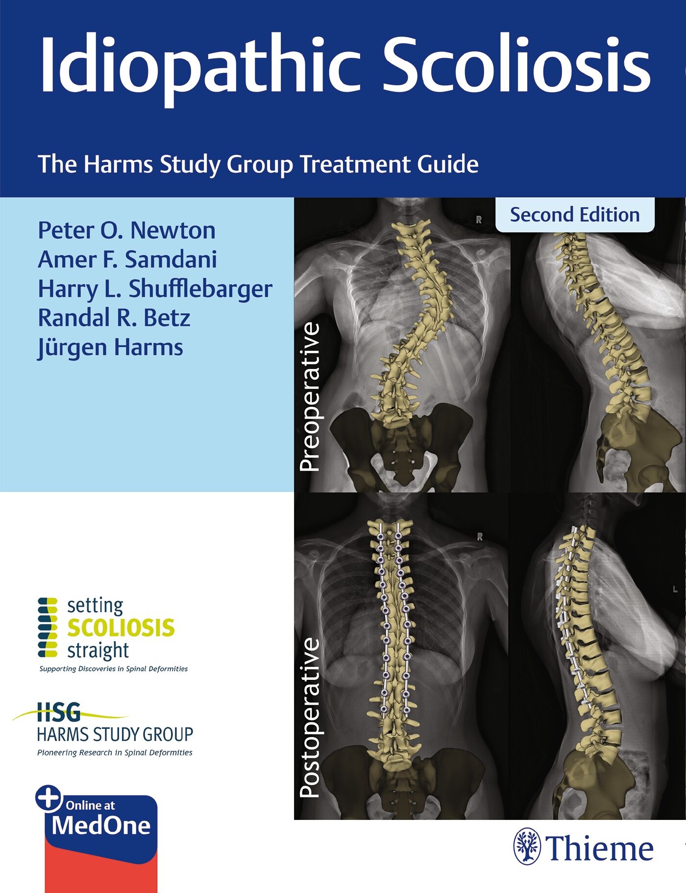 Idiopathic Scoliosis, 9781638536413