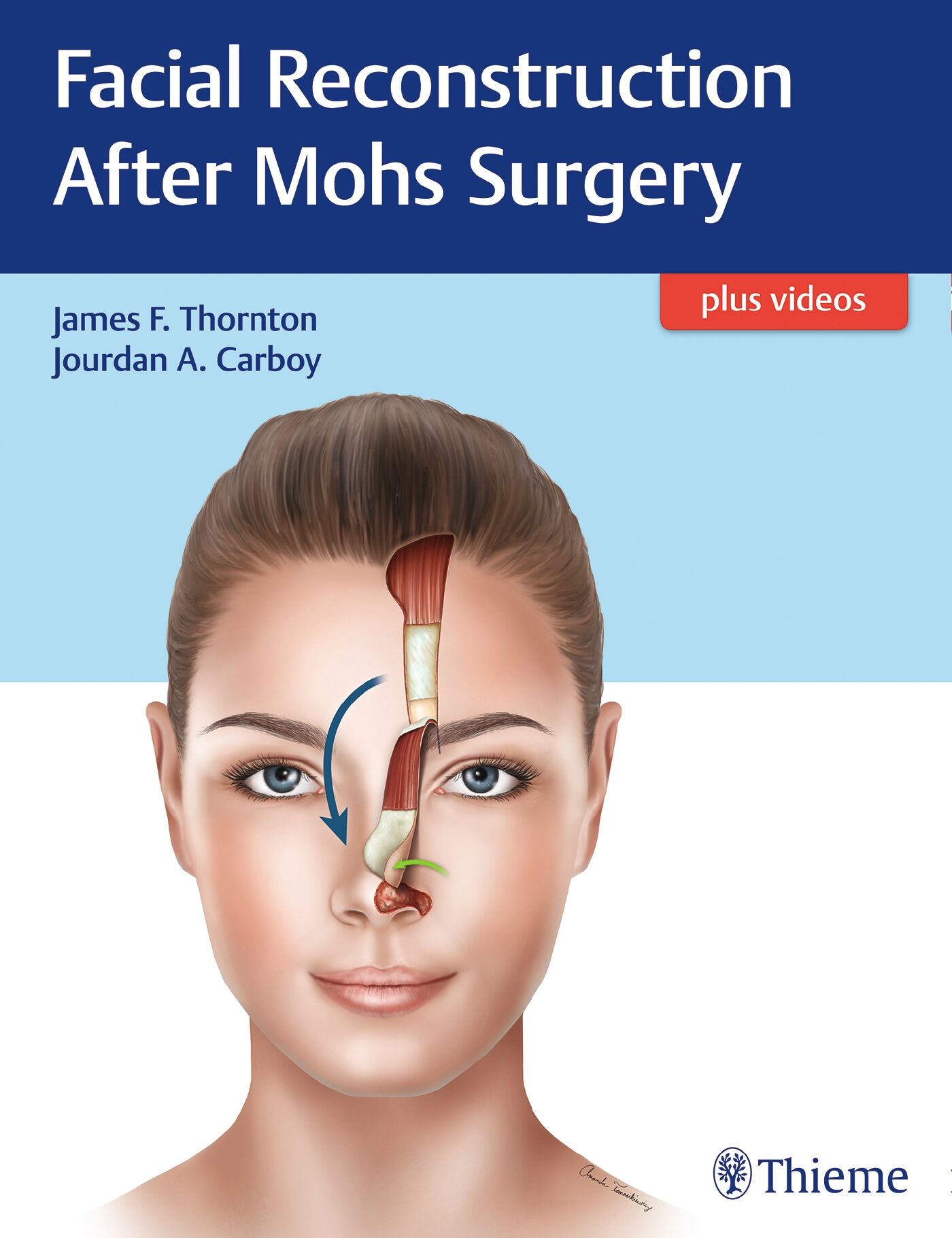 Facial Reconstruction After Mohs Surgery, 9781626237346