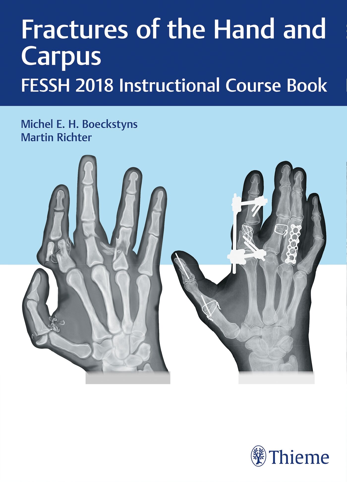 Fractures of the Hand and Carpus, 9783132417205