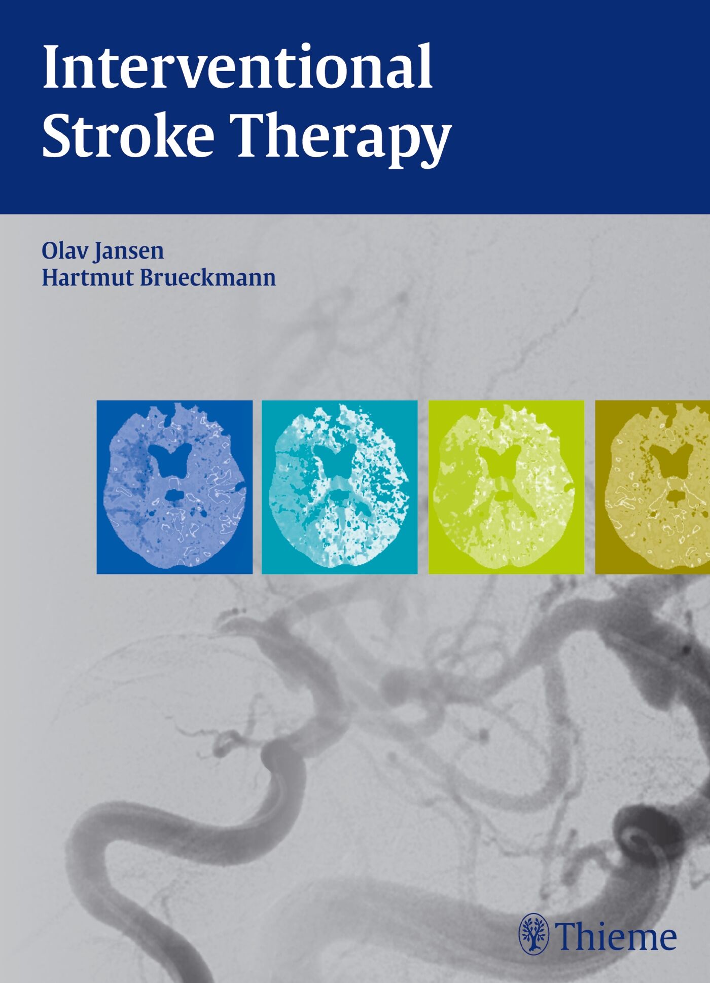 Interventional Stroke Therapy, 9783131699213