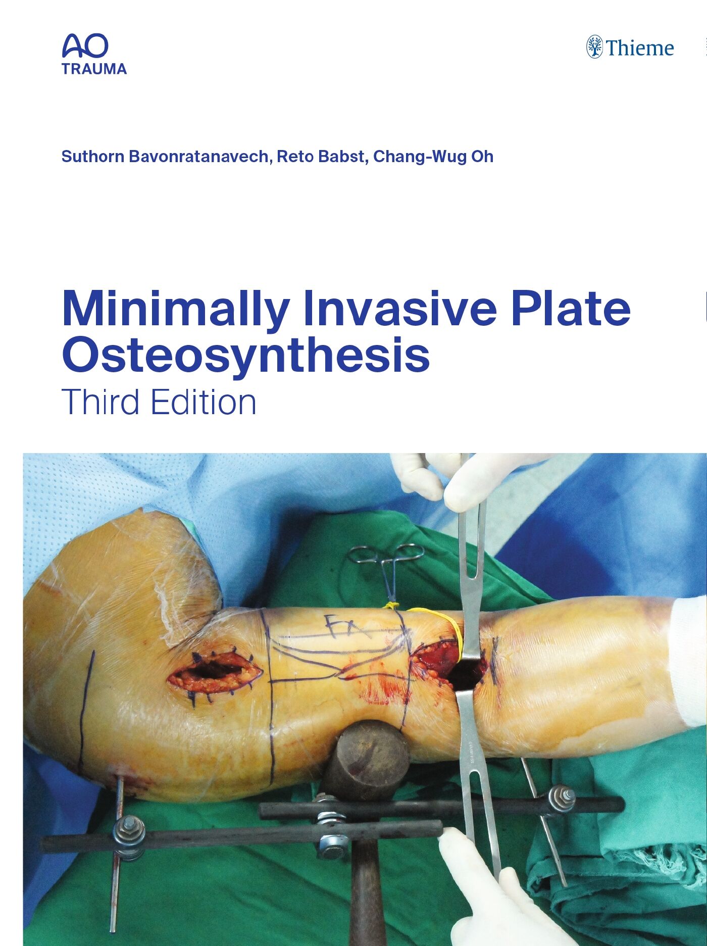 Minimally Invasive Plate Osteosynthesis, 9783132454279