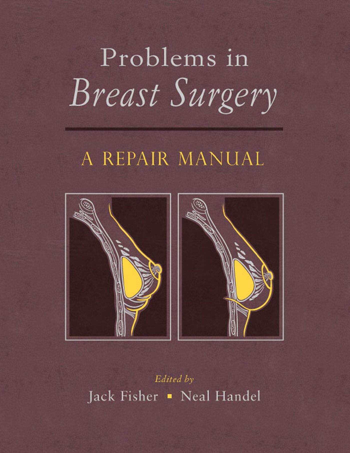 Problems in Breast Surgery, 9781626236875