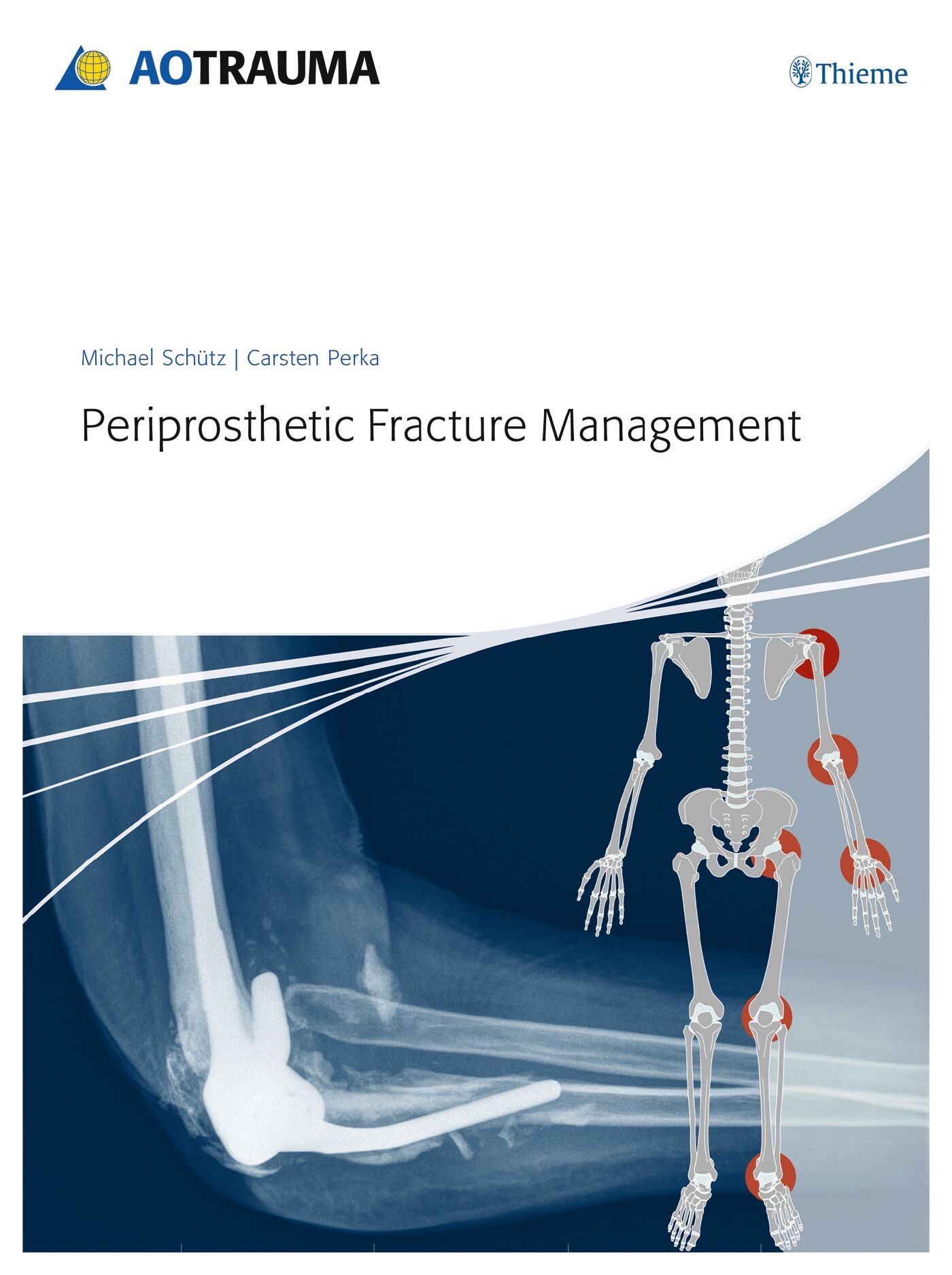 Periprosthetic Fracture Management, 9783131715111