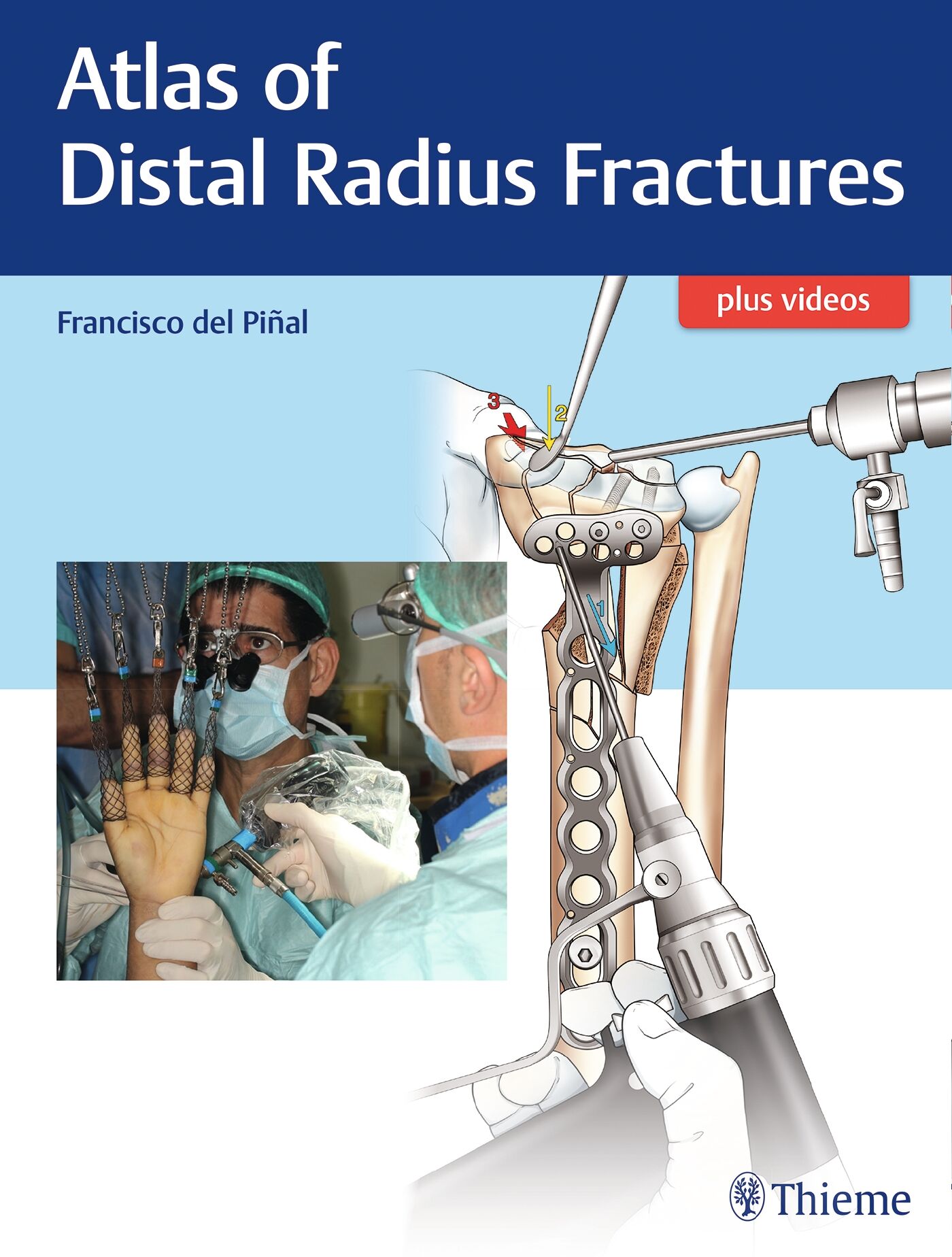 Atlas of Distal Radius Fractures, 9781626236790
