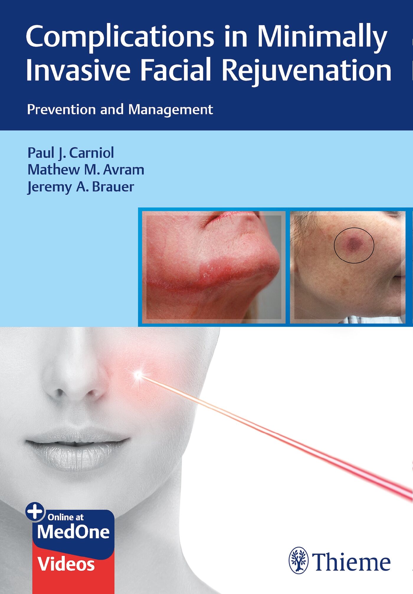Complications in Minimally Invasive Facial Rejuvenation, 9781638536253