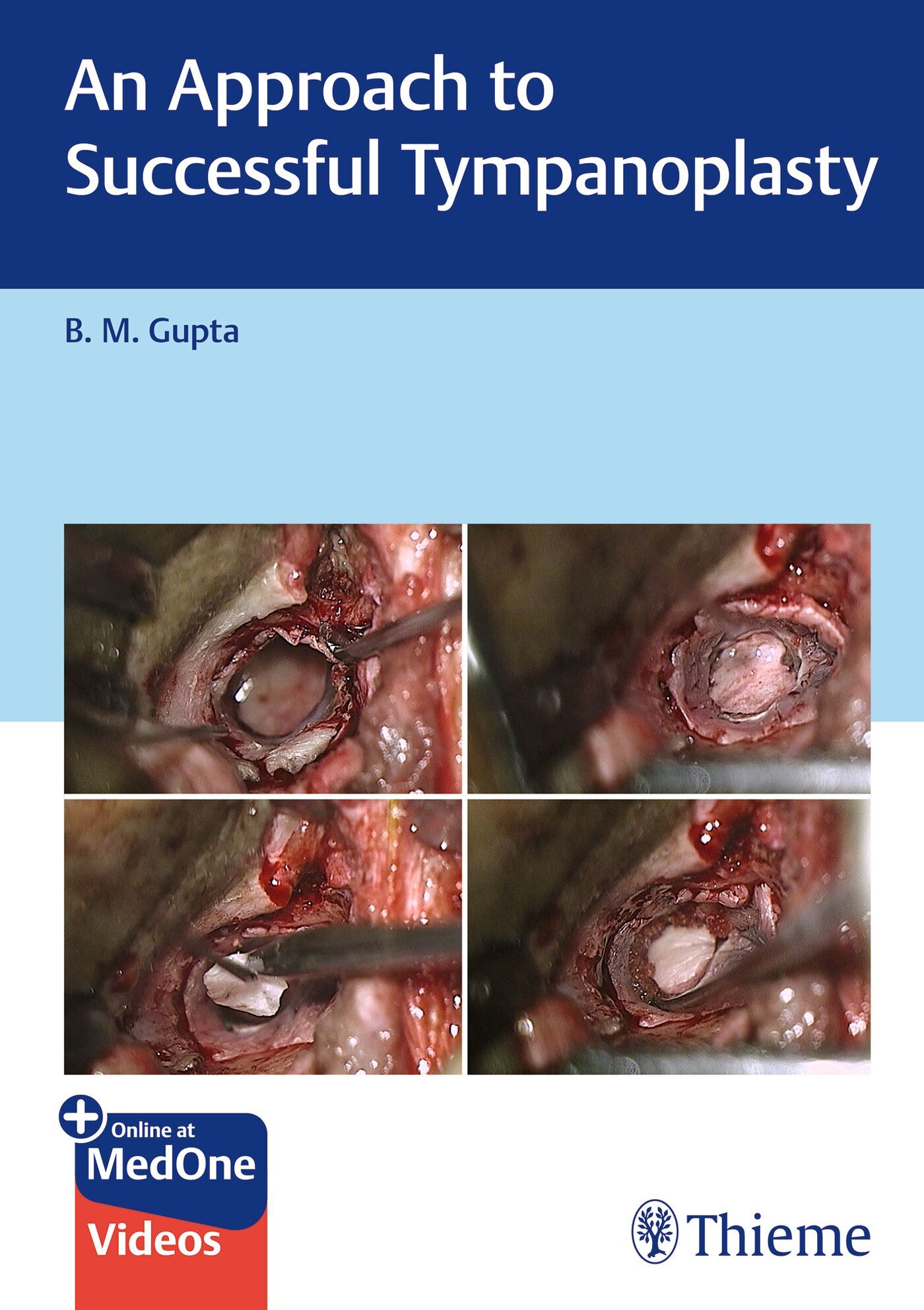 An Approach to Successful Tympanoplasty, 9789395390934