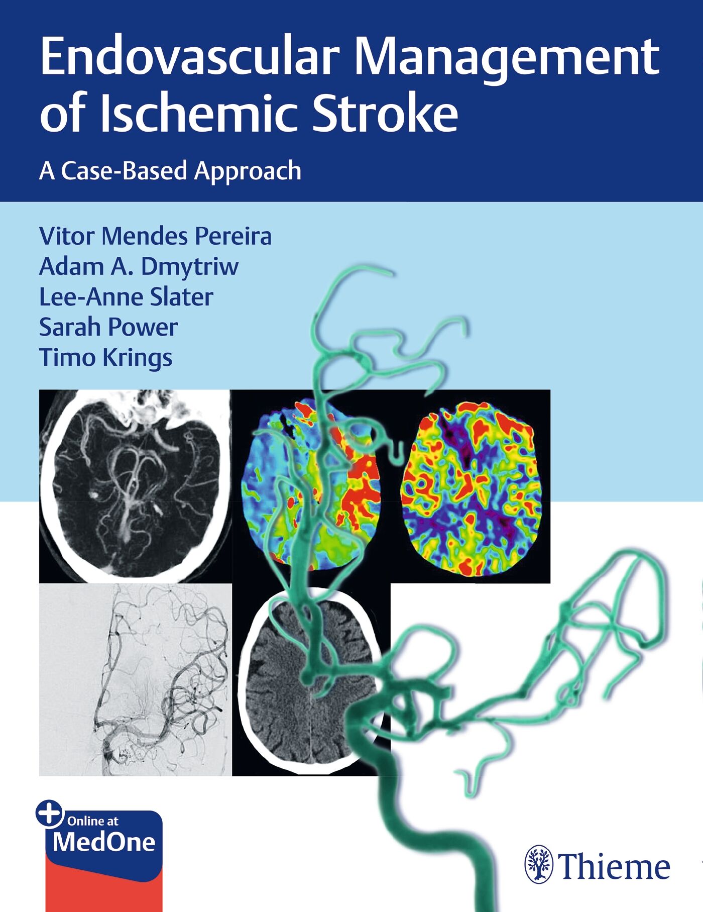 Endovascular Management of Ischemic Stroke, 9781626232761