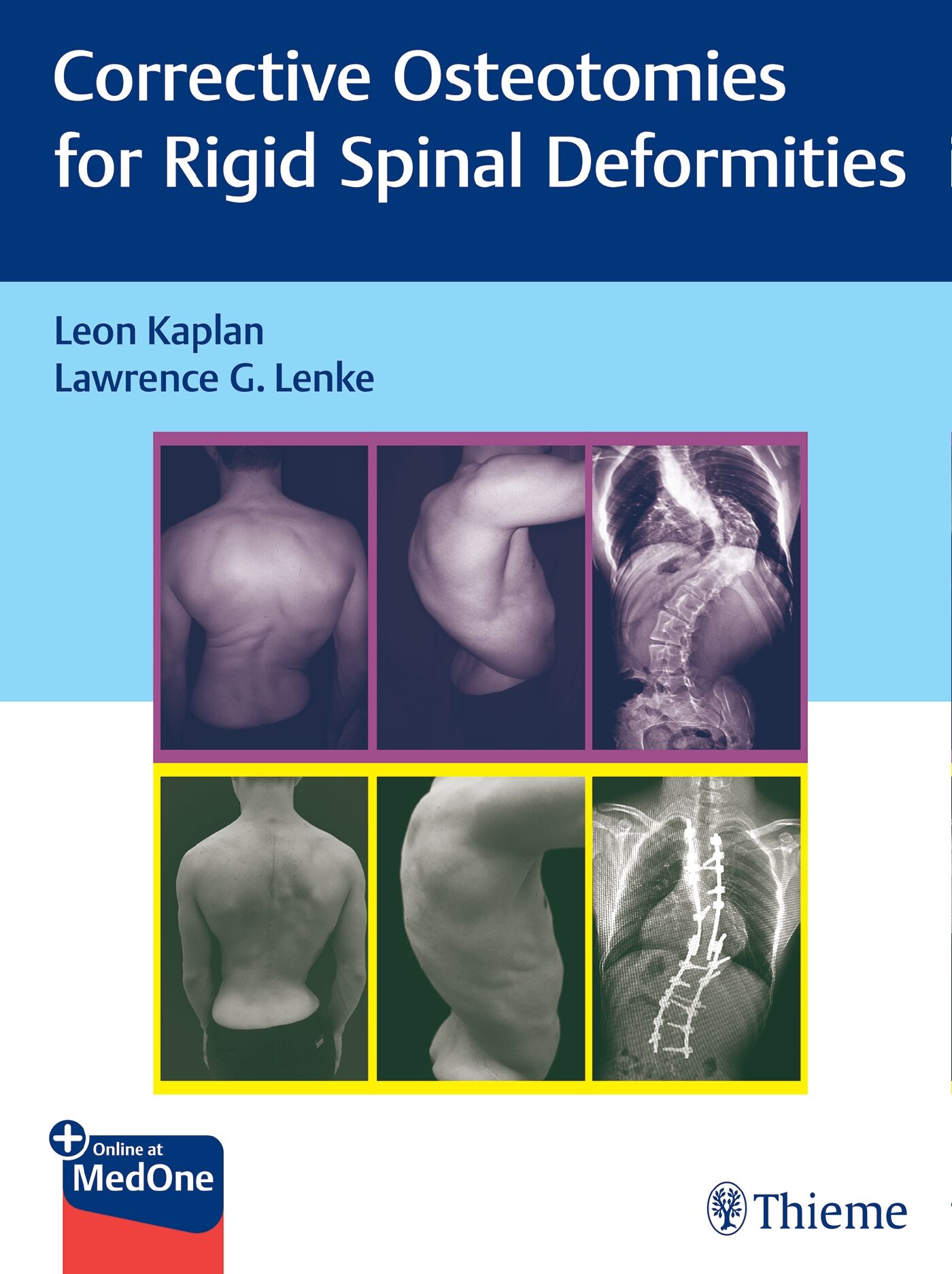 Corrective Osteotomies for Rigid Spinal Deformities, 9783131730916