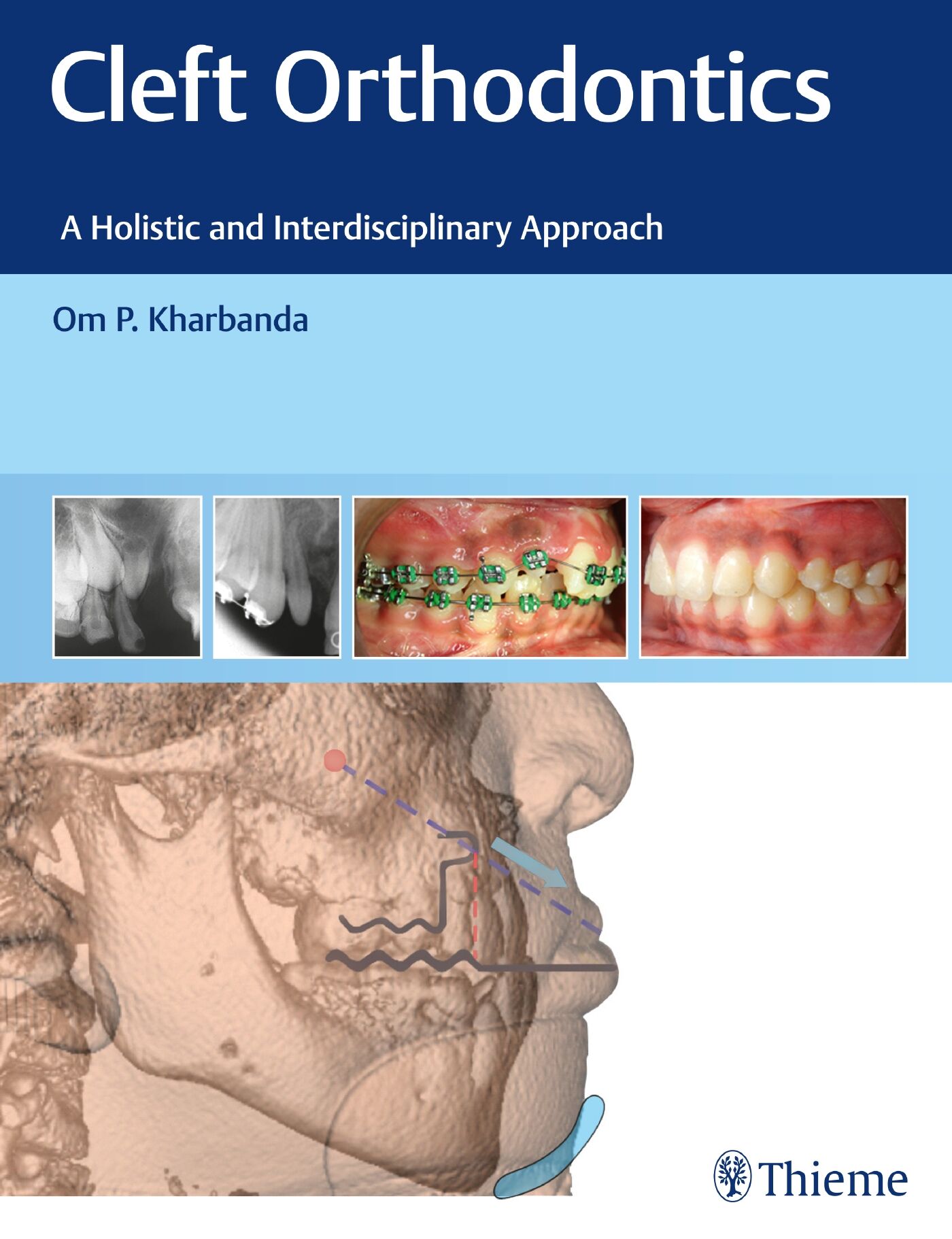 Cleft Orthodontics, 9788194857082