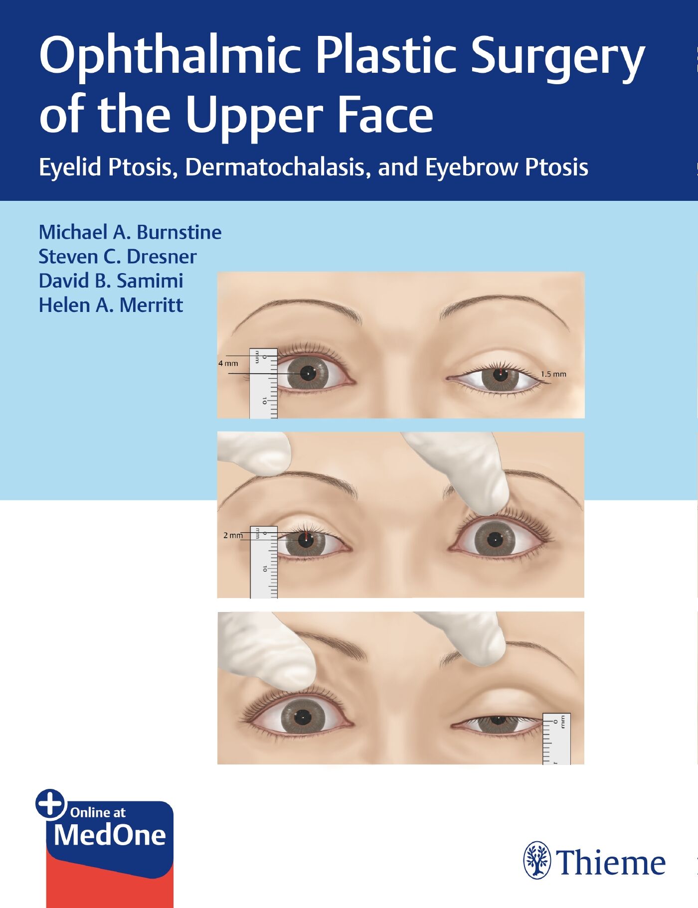 Ophthalmic Plastic Surgery of the Upper Face, 9781626239210