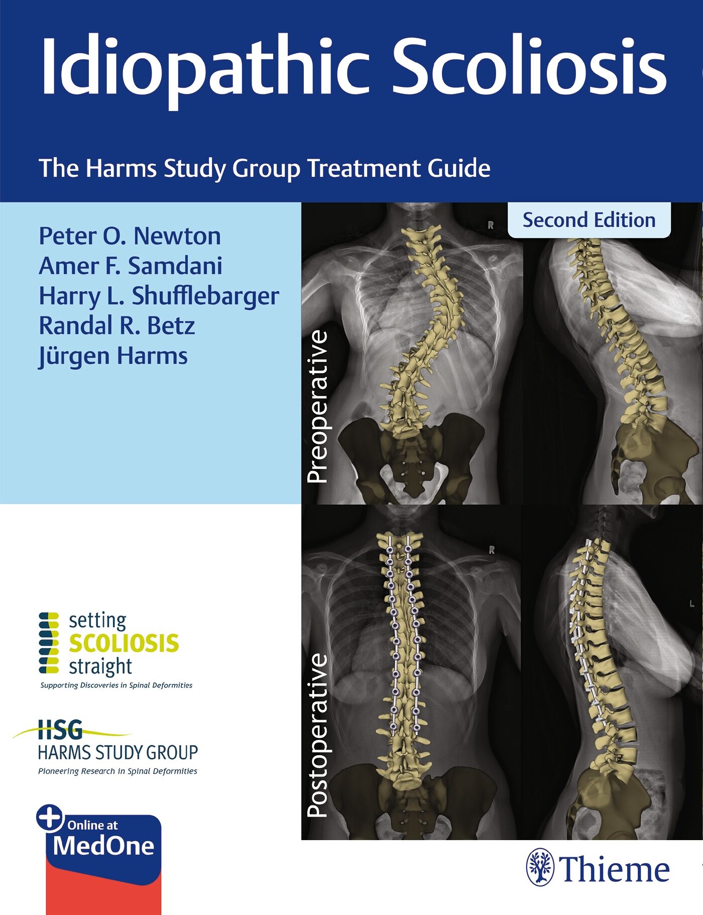 Idiopathic Scoliosis, 9781684200559