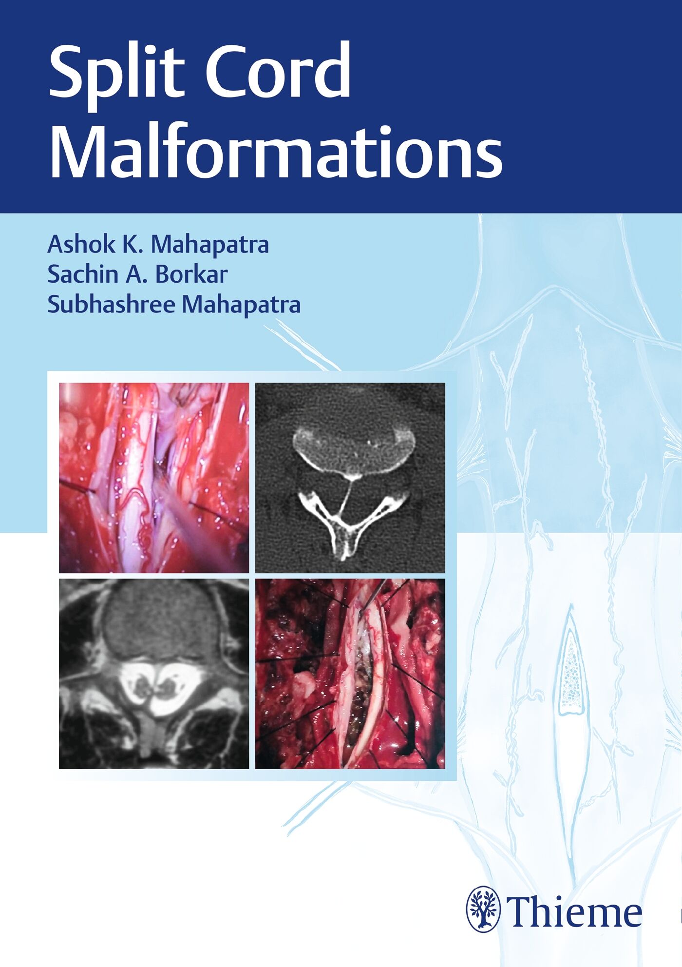 Split Cord Malformations, 9788194857099