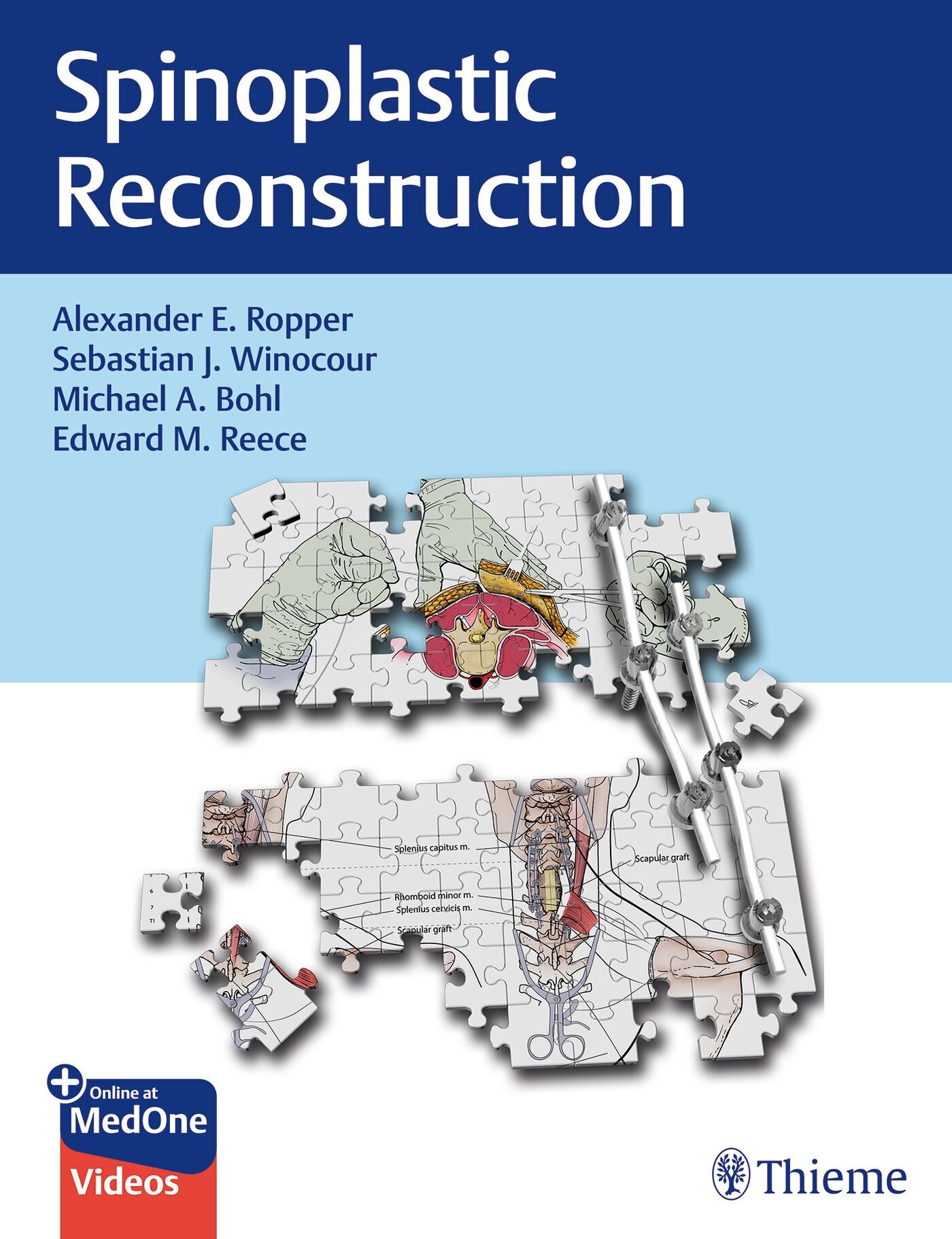 Spinoplastic Reconstruction, 9781684205011