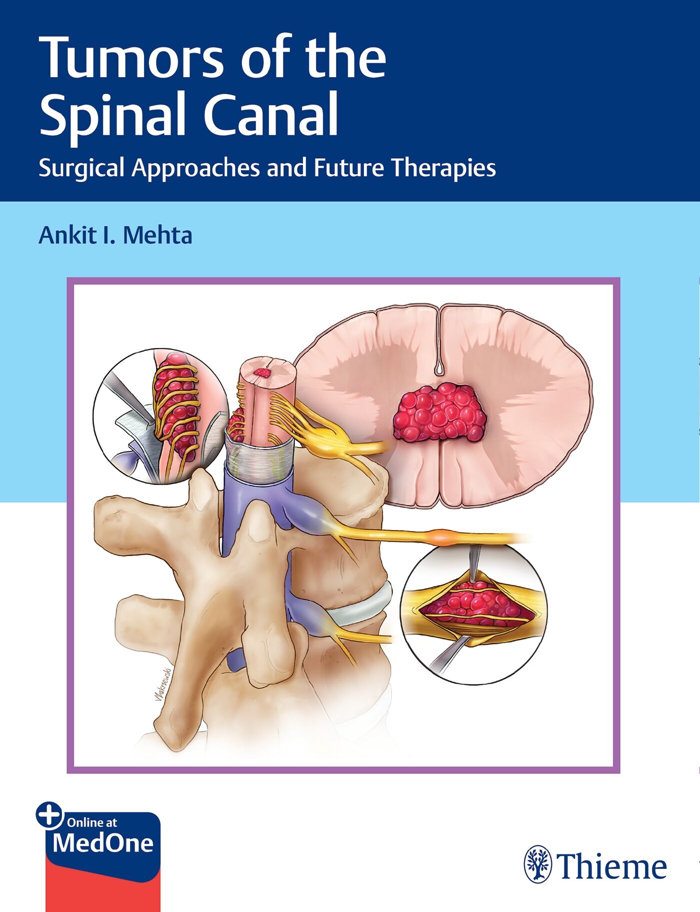Tumors of the Spinal Canal, 9781626239319