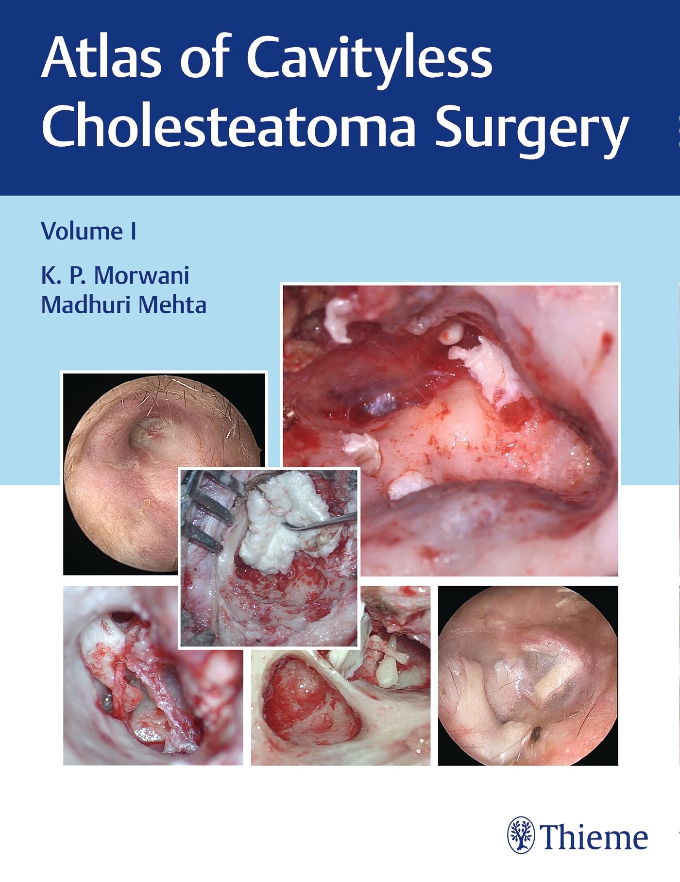 Atlas of Cavityless Cholesteatoma Surgery, Vol 1, 9789386293411