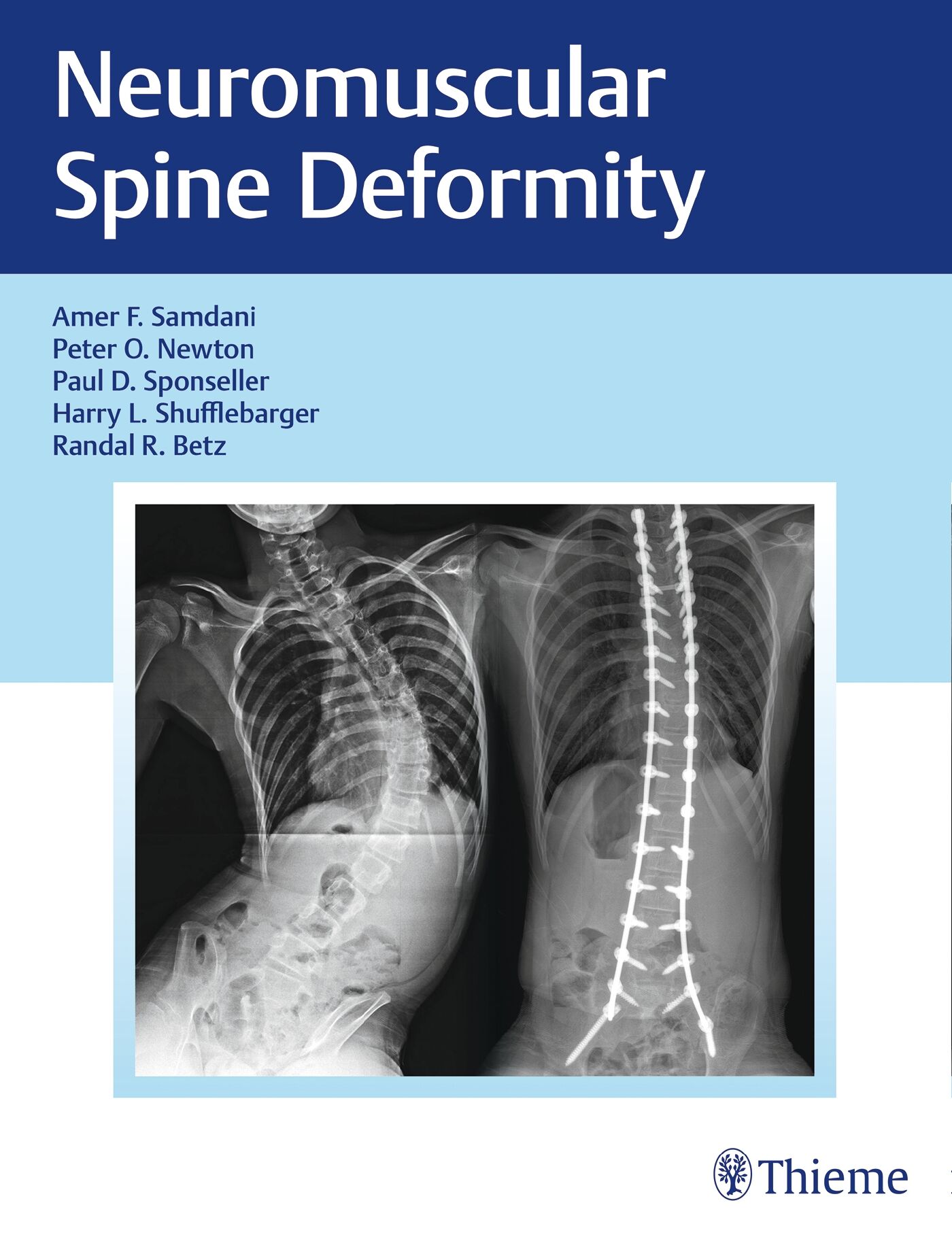 Neuromuscular Spine Deformity, 9781626232600