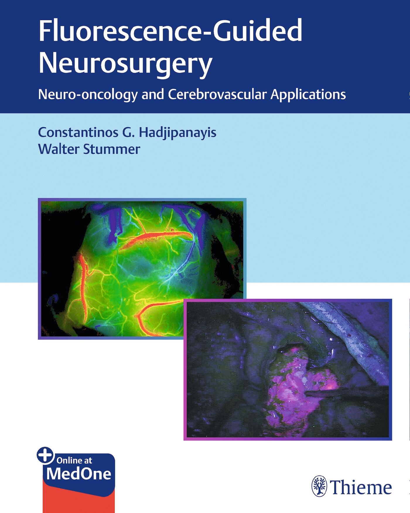 Fluorescence-Guided Neurosurgery, 9781626237148