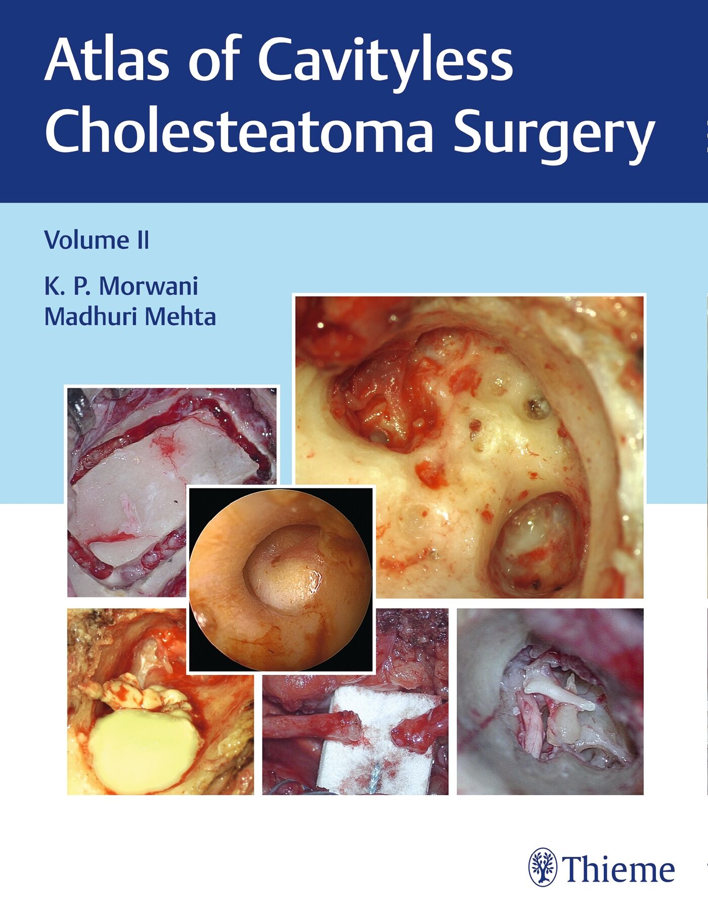 Atlas of Cavityless Cholesteatoma Surgery, Vol 2, 9789388257190