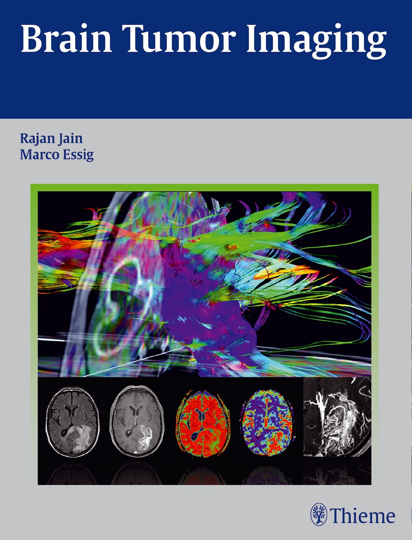 Brain Tumor Imaging, 9781604068061
