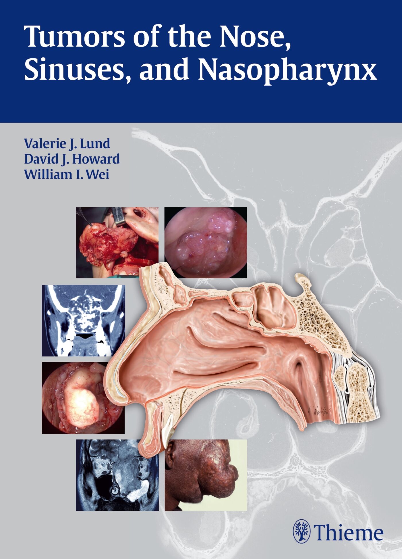 Tumors of the Nose, Sinuses and Nasopharynx, 9783131471918